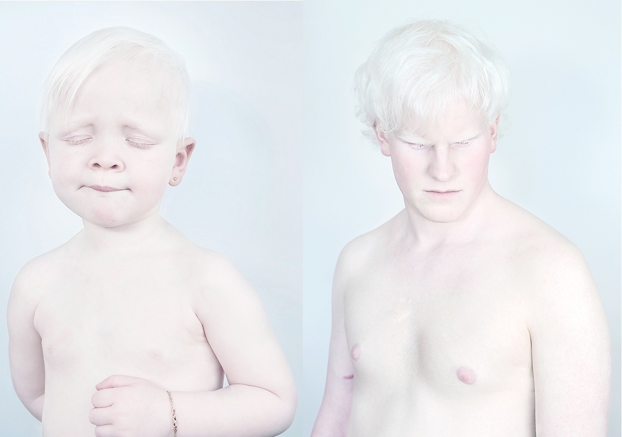 Lenyűgöző portrék albínó emberekről