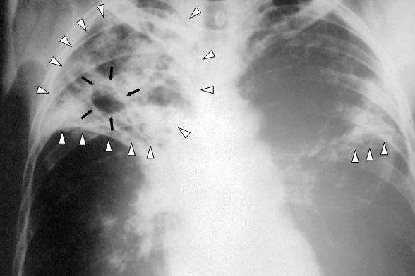 Tbc-s tüdő (fotó: Wikipedia.org)